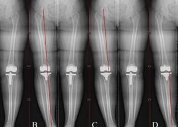 AI instrument precisely completes leg size measurements as much as 87% sooner than human readers