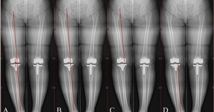 AI instrument precisely completes leg size measurements as much as 87% sooner than human readers